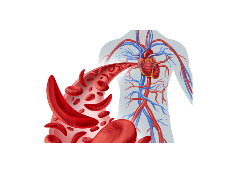 Anemija srpastih stanica