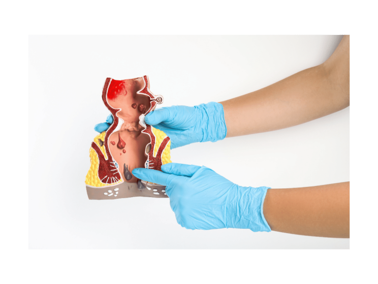 Kako izgledaju vanjski hemoroidi i kako ih se riješiti